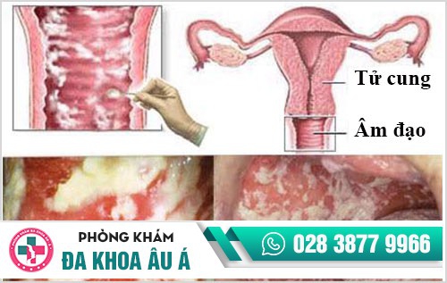 mụn sinh dục