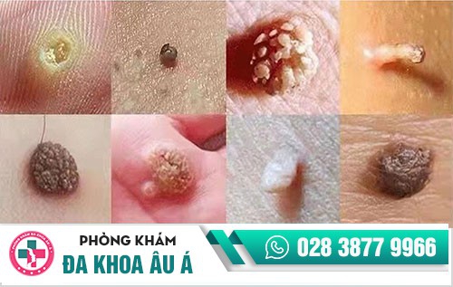 điều trị sùi mào gà ở đâu,trị sùi mào gà ở đâu uy tín, nên điều trị sùi mào gà ở đâu