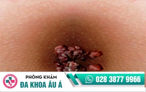 điều trị sùi mào gà ở đâu,trị sùi mào gà ở đâu uy tín, nên điều trị sùi mào gà ở đâu