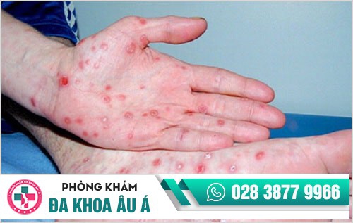 Bệnh giang mai nguy hiểm như thế nào?