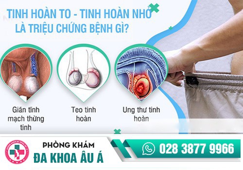 Sưng tinh hoàn một bên là dấu hiệu bệnh gì