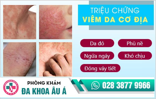 Cảnh giác với bệnh viêm da cơ địa hay gặp