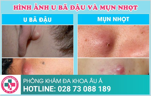 tiểu phẫu u bã đậu