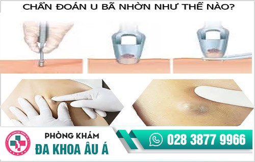 Tổng quan về u nang bã nhờn, nguyên nhân và cách điều trị