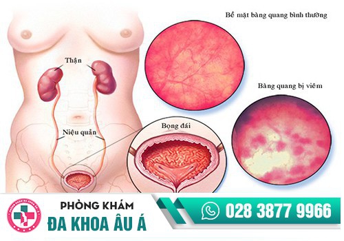 VIÊM BÀNG QUANG CÓ BIỂU HIỆN RA SAO?