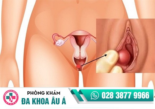 SƯNG VÙNG KÍN LÀ BỆNH GÌ?